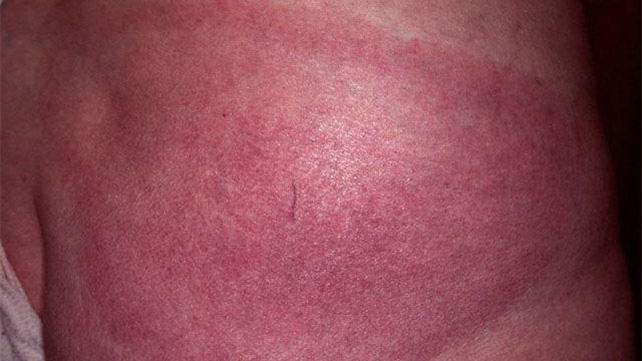 Erythema migrans 